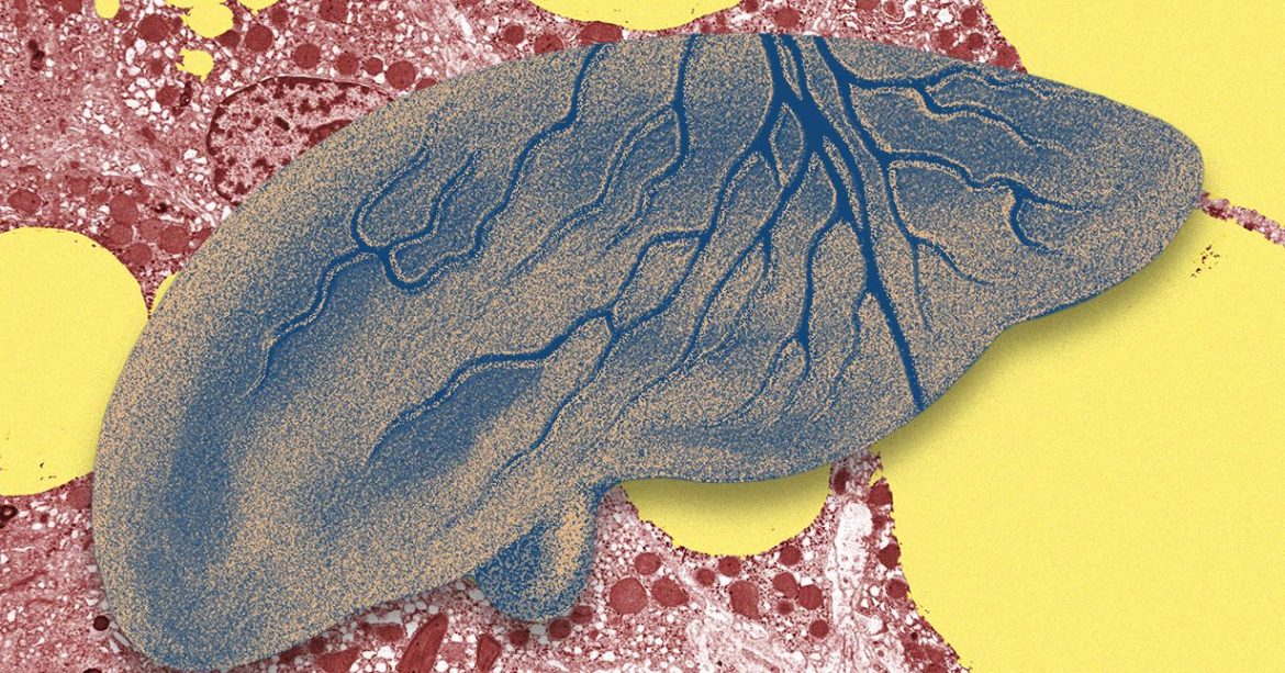 There’s a Fatty Liver Epidemic. AI Could Help Get Ahead of It